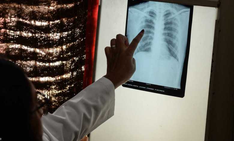 La tuberculose : Au Maroc, près de 30.000 personnes mises sous traitement en 2021